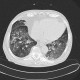 Alveolar hemorrhage, acute stage: CT - Computed tomography